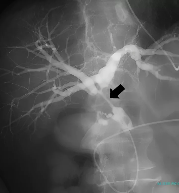 Cholangiography