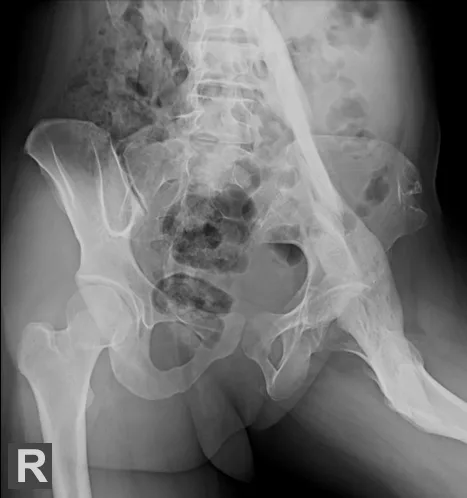 X-ray on a patient with Fibrous Ossificans Progressiva