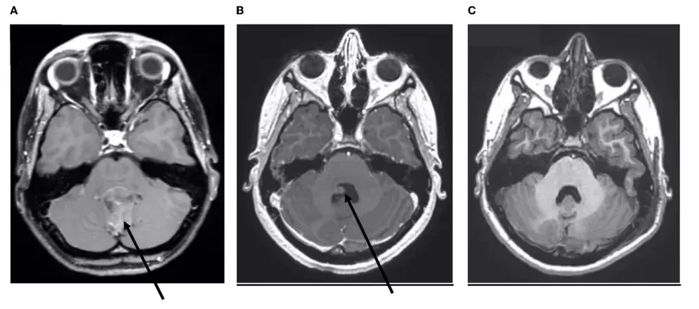  Imaging of one patient with ependymoma, at different times