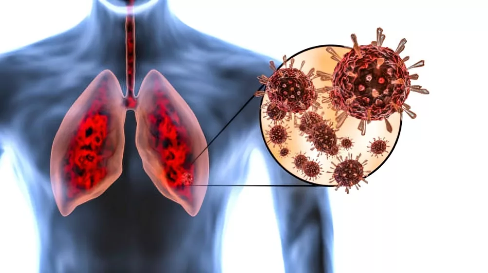 prodromal phase of hantavirus pulmonary syndrome