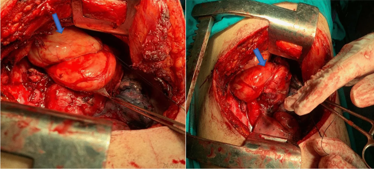 Mediastinal liposarcoma