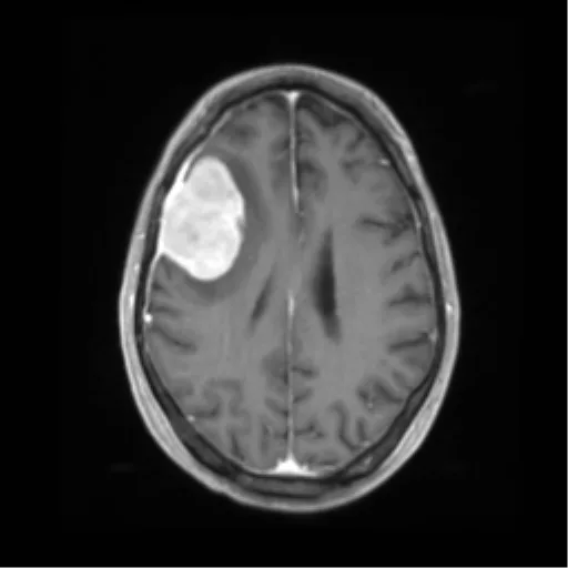 Meningioma