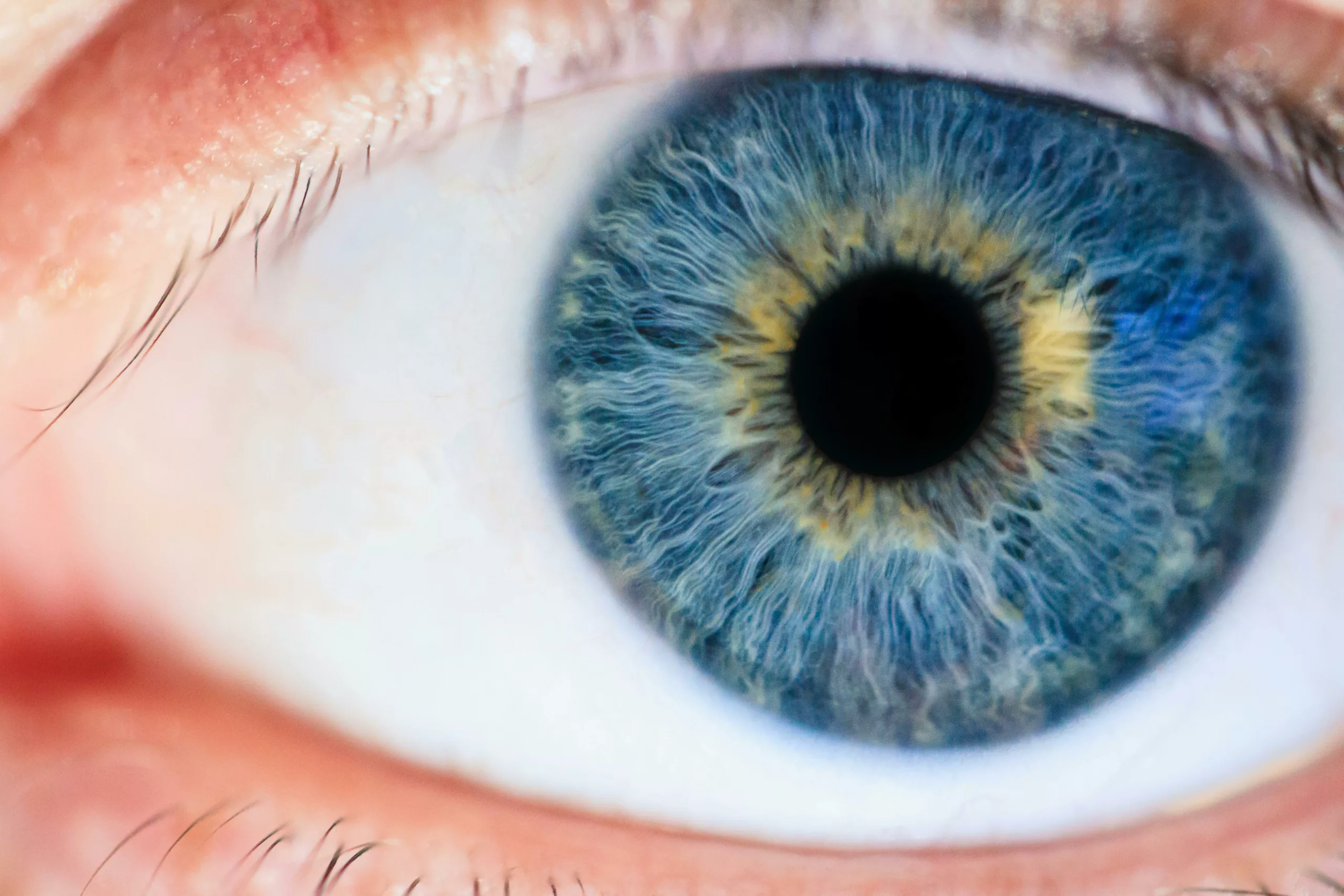 Blue eyes are risk factors for uveal melanoma