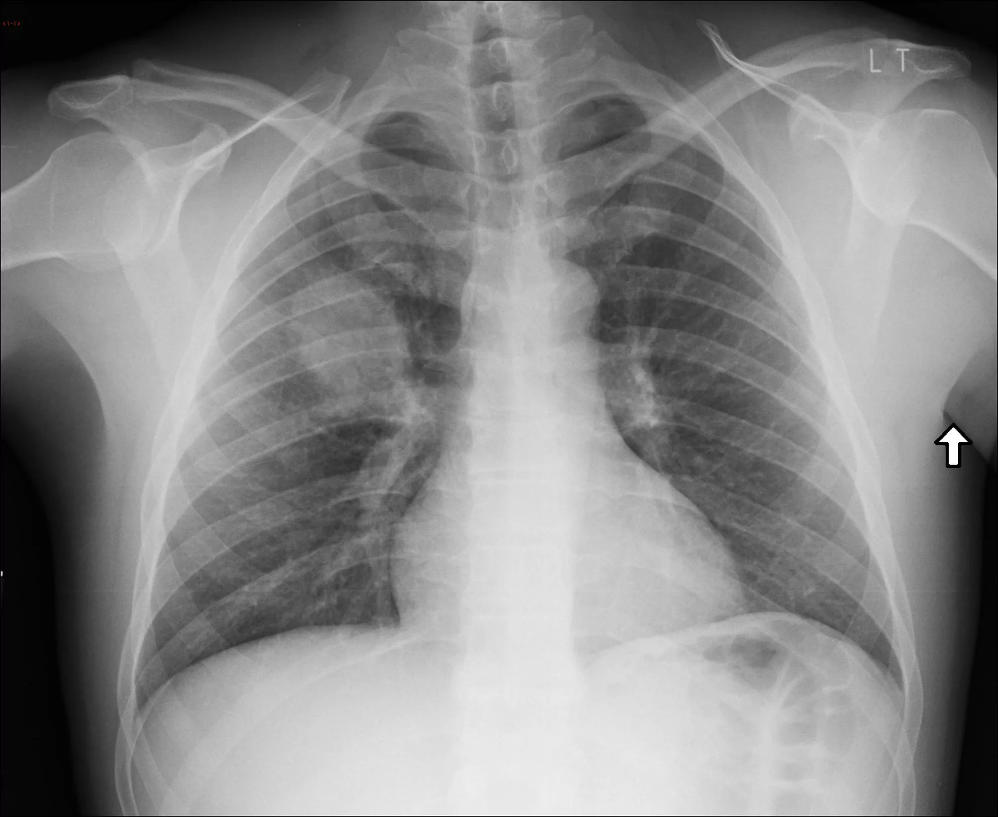 Q fever pneumonia