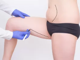 Marking for Thighplasty