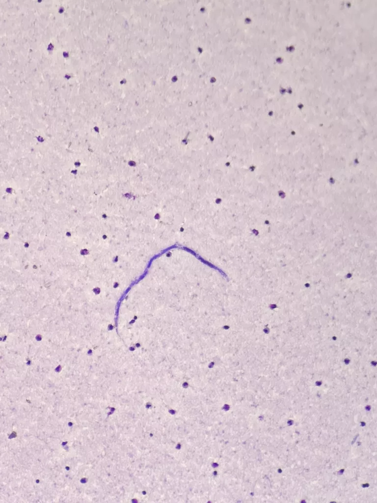 Image shows Microfilaria of Loa loa in a thin blood smear