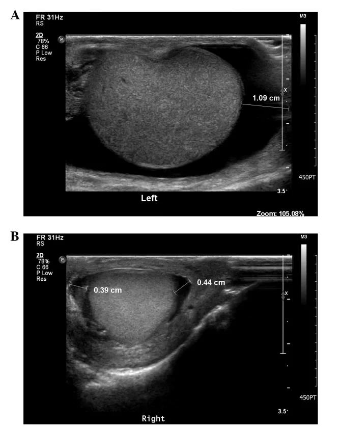 Scrotal ultrasonography