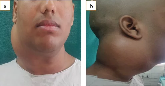 Clinical picture showing Front and Side view of the Neck Swelling owing to Myxofibrosarcoma