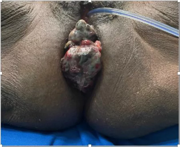 Anorectal mucosal melanoma