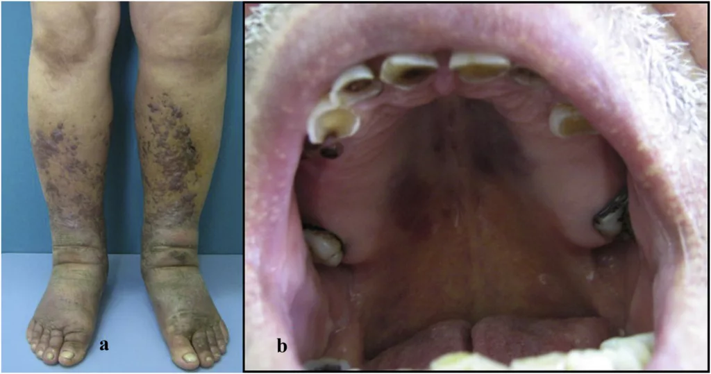 Skin and Oral lesions in Kaposi Sarcoma