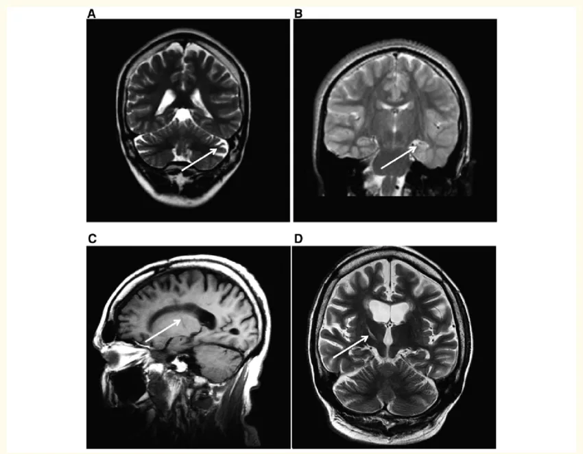 MRI Brain of a patients with Dravet syndrome