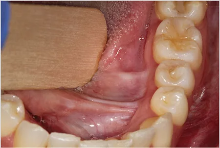 Oral mucosal melanoma after surgery