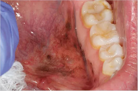 Oral mucosal melanoma