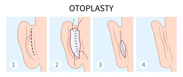 Procedure of Otoplasty explained briefly