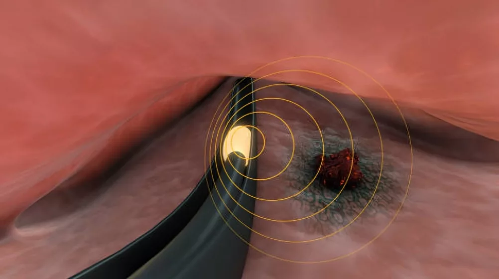 Brachytherapy of cervical cancer