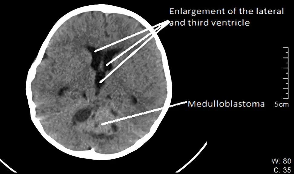 Medulloblastoma in posterior fossa for V.F. patient on CT scan