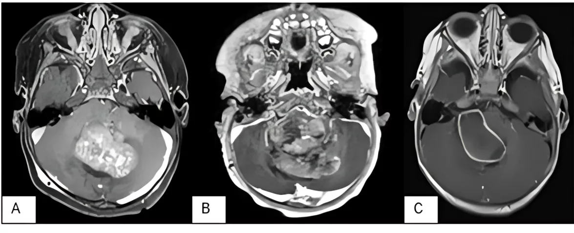 Posterior fossa tumors A: Medulloblastoma; B: Atypical Teratoid Rhabdoid Tumor; C: Ependymoma