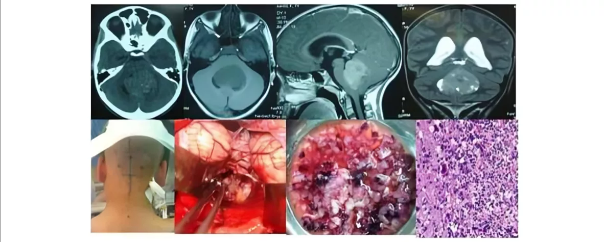 CT scan and MR images of Medulloblastoma in a 12-year-old male child