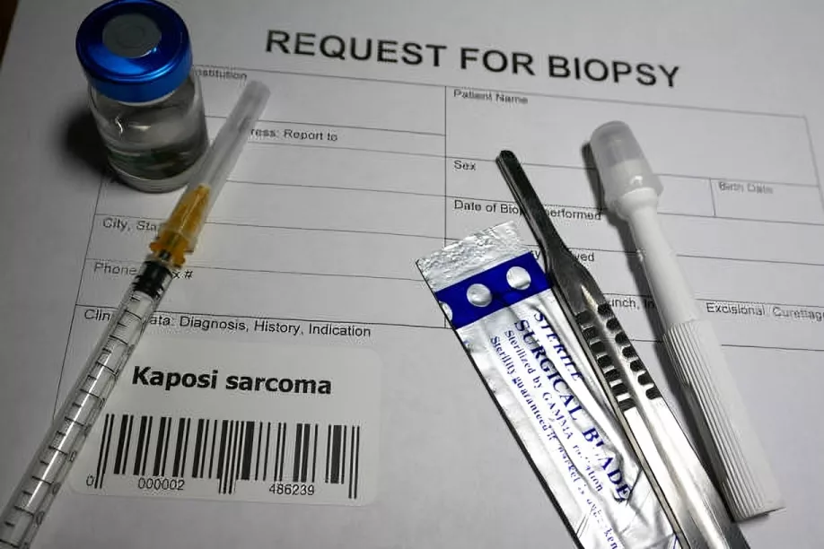 Biopsy for Kaposi Sarcoma