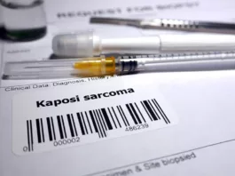 Kaposi Sarcoma