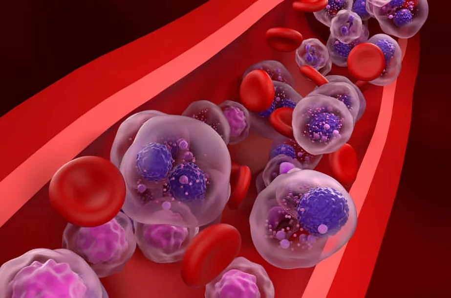 Myeloma cells in blood circulation