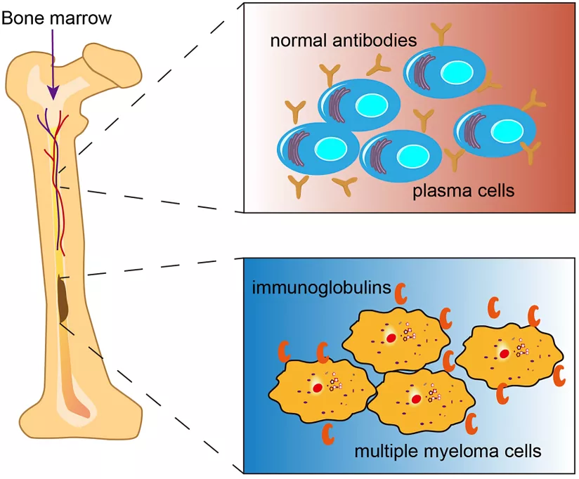 Multiple myeloma