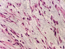 Myxofibrosarcoma