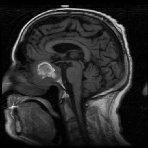 Sinonasal mucosal melanoma